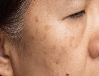 Age Spots