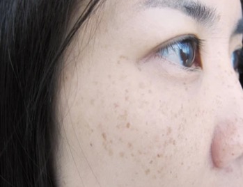 Freckles