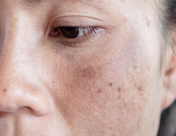 Melasma