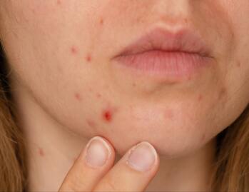 Acne Scars