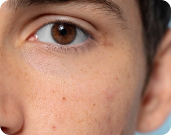 Hyperpigmentation