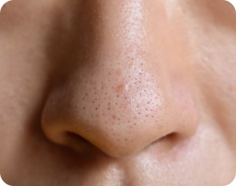 Enlarge Pores