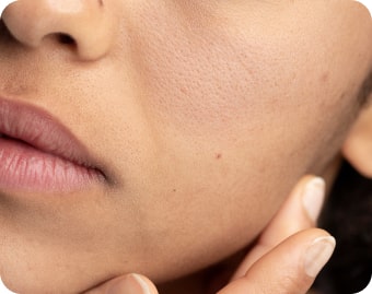 Uneven Skin Stone